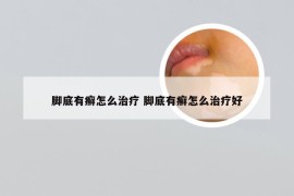 脚底有癣怎么治疗 脚底有癣怎么治疗好